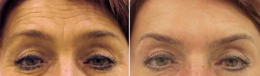 Verjüngung des Feldes der Stirn